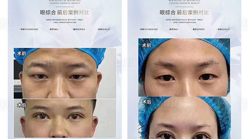 硅胶隆鼻取出后，你的修复之路该怎样走？**