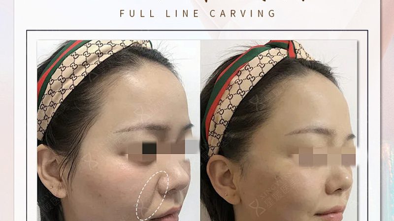 瘦脸贴片与瘦脸面膜：揭秘两者差异与选择要点