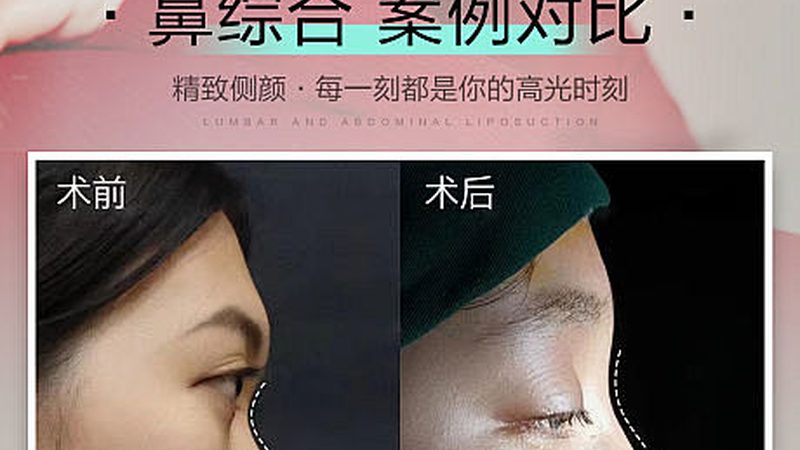 玻尿酸与自体脂肪：填脸颊，哪种选择更合适？**