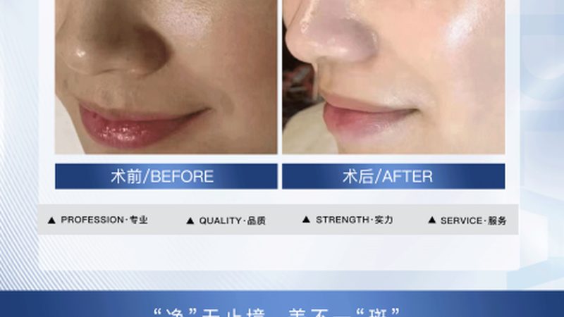 西安削骨手术：揭秘价格构成与选择要点
