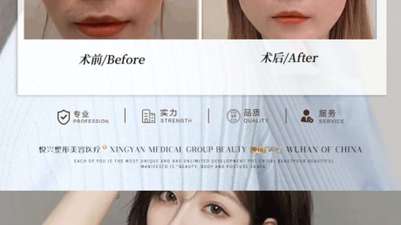 激光祛斑适合于各种色斑，如雀斑、晒斑、老年斑等。但以下人群不适合激光祛斑：