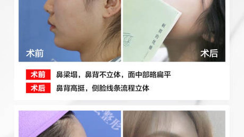 揭秘国产肉毒素去狐臭：技术原理与选择要点