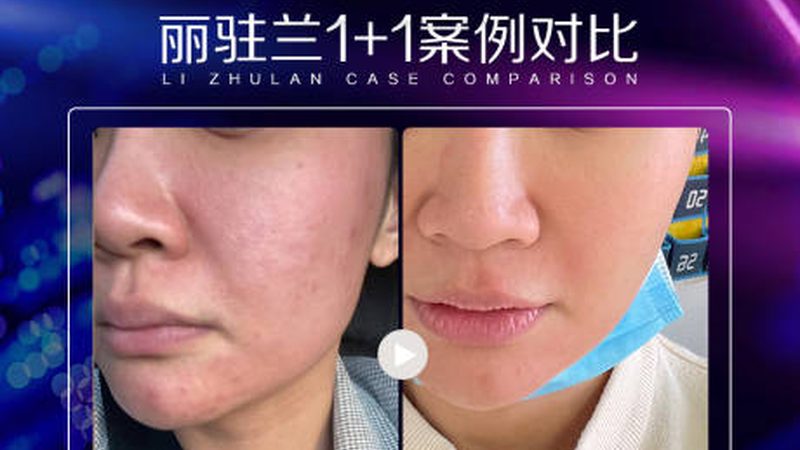 IPL激光祛斑仪：揭秘其原理与品牌选择要点