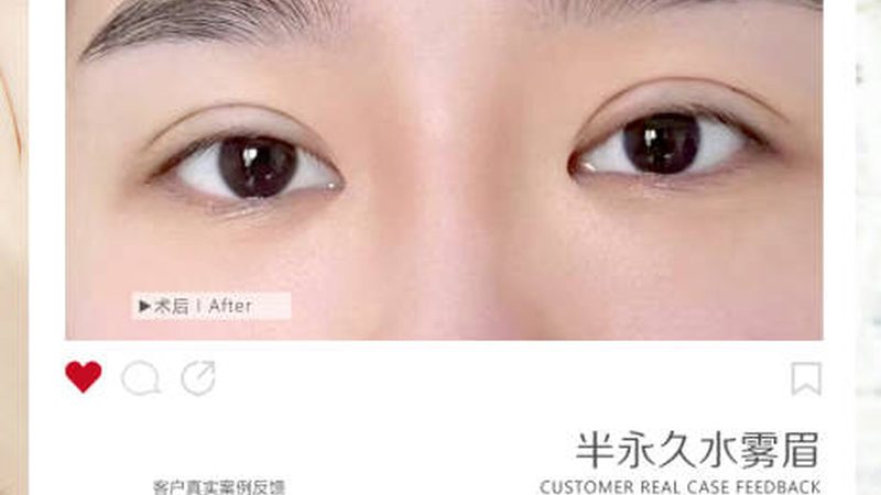 揭秘激光祛斑：北京常用仪器型号及关键参数解析