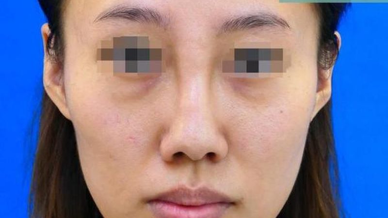 超声炮面部提升：揭秘技术原理与价格因素**
